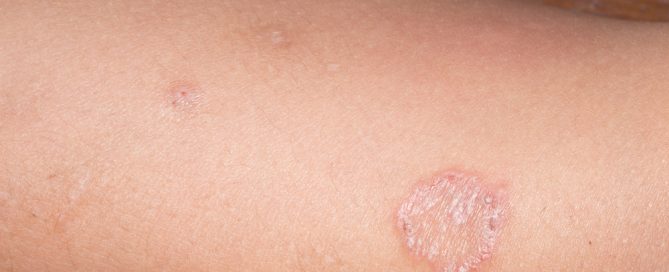 what does ringworm look like- what are the symptoms of ringworm and what is the treatment for ringworm