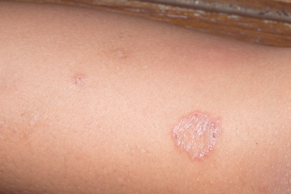 what does ringworm look like- what are the symptoms of ringworm and what is the treatment for ringworm