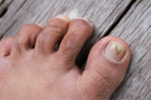 treatment for fungal toenail infection
