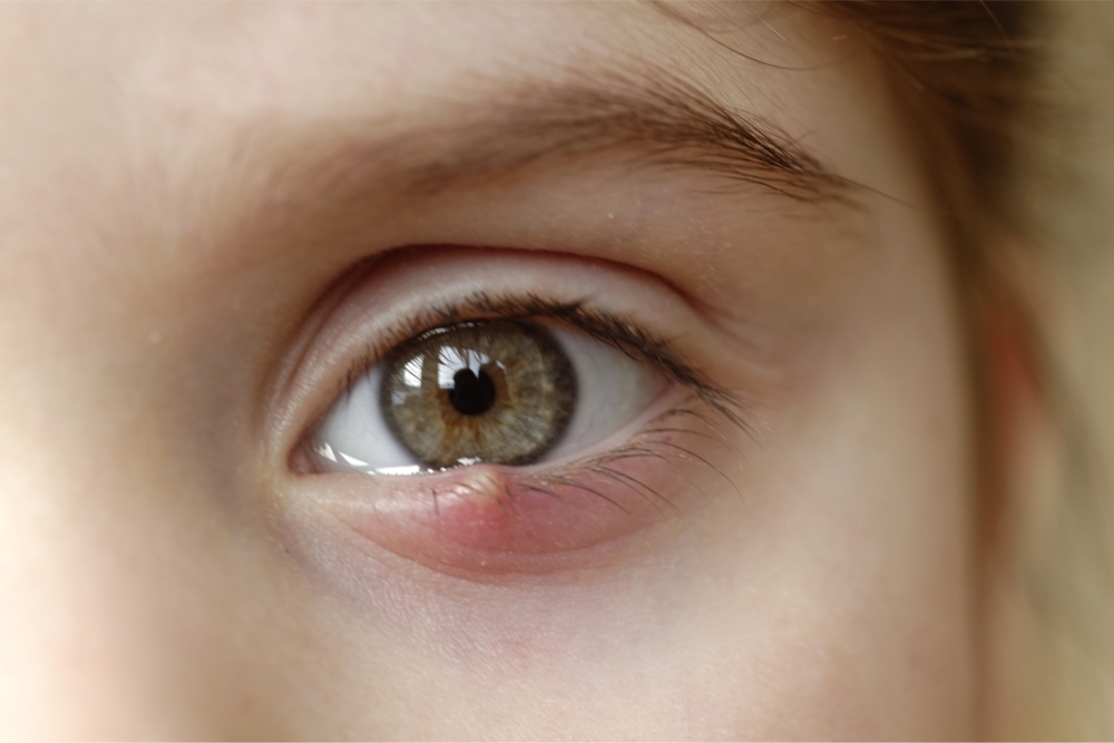 What is a stye and how do you treat it? Qoctor your quick online doctor