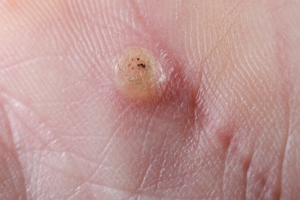 Warts on foot how to remove - Foot wart black spots