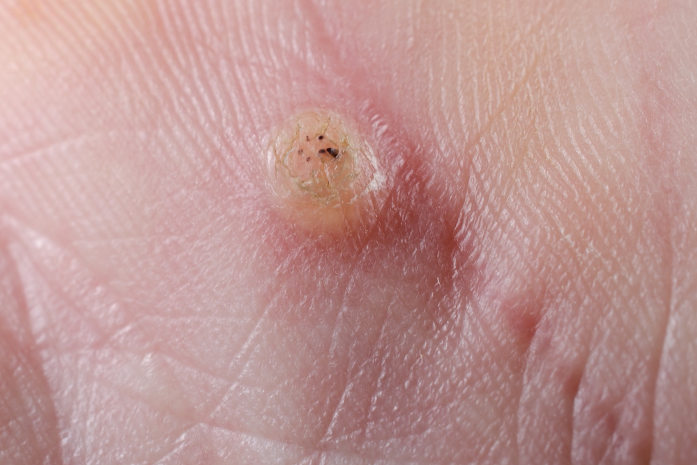 wart on foot black spot