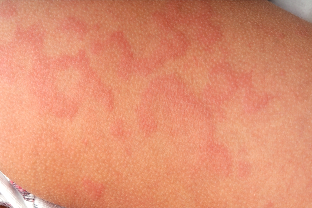 A close up picture of a person who as hives, also known as urticaria. But what causes urticaria?