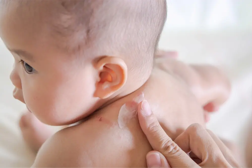 a baby who is getting treatment for school sores (impetigo)
