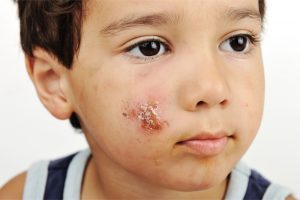 what are school sores and how do you treat school sores