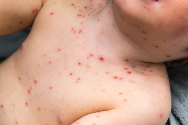 Chicken Pox- symptoms & key facts | Qoctor your online doctor