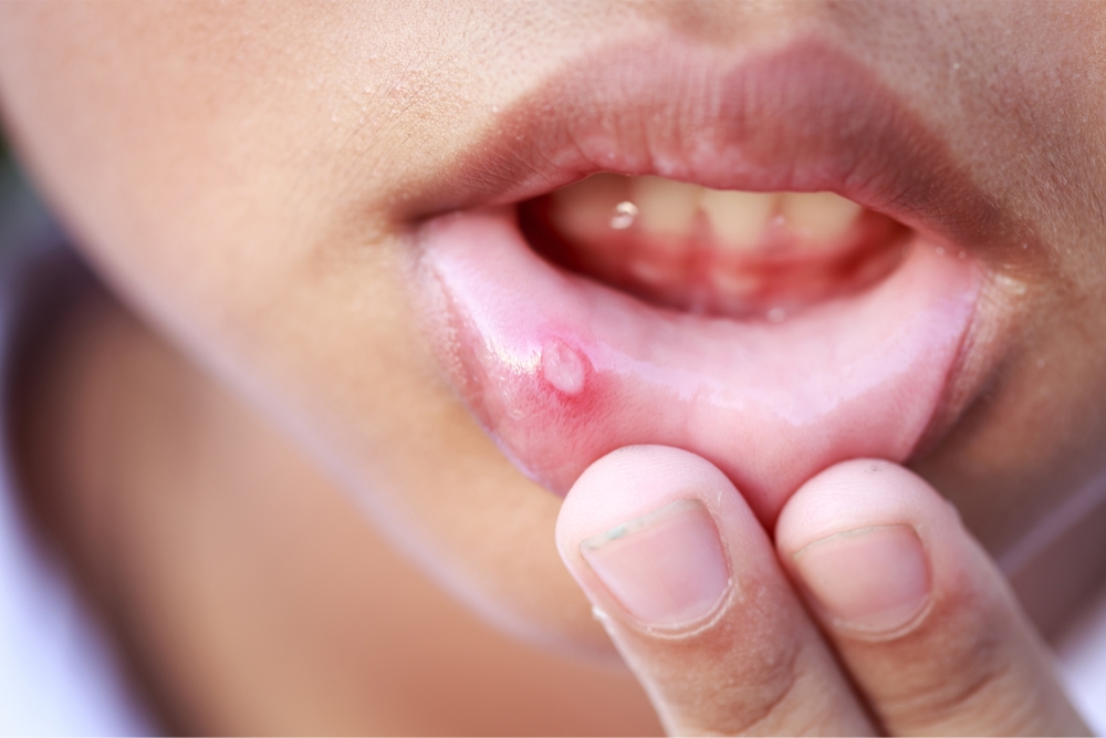 what causes mouth ulcers? are mouth ulcers contagious?