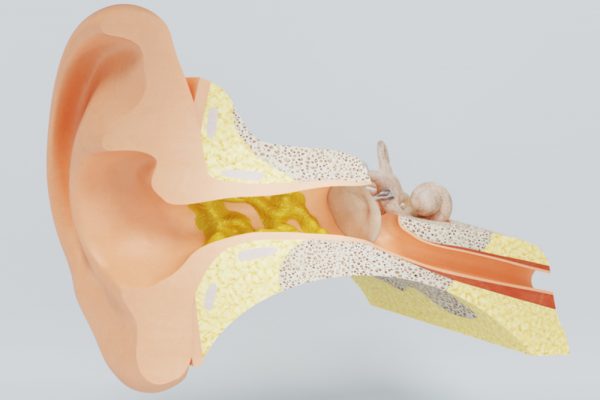 impacted ear wax home removal