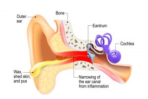 symptoms of swimmer's ear otitis externa