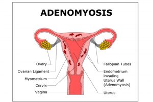 what is adenomyosis?