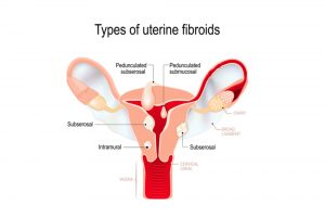 what are fibroids, symptoms of fibroids