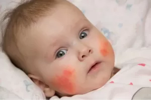 what is eczema