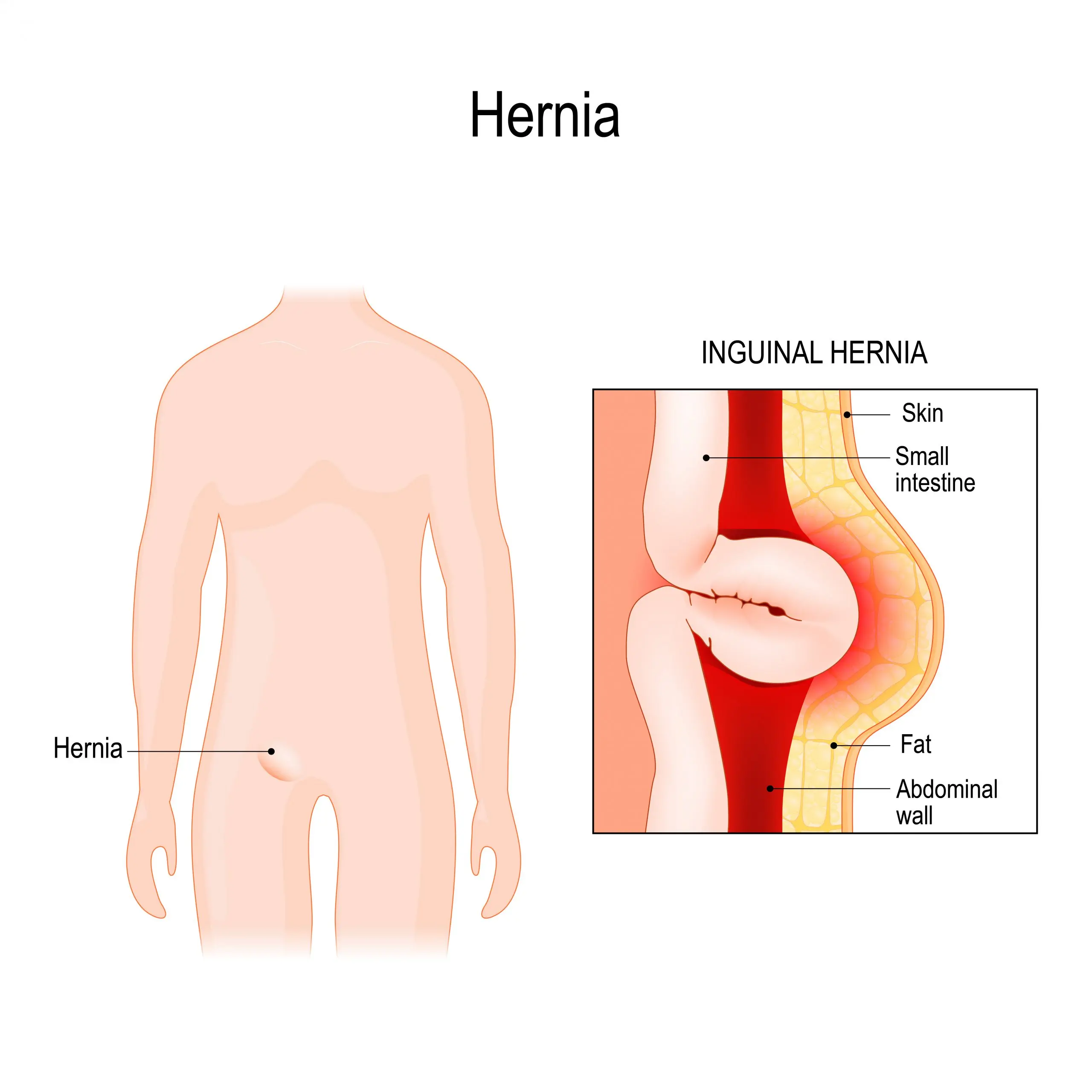 Inguinal hernia