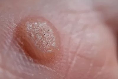 Anogenital Warts