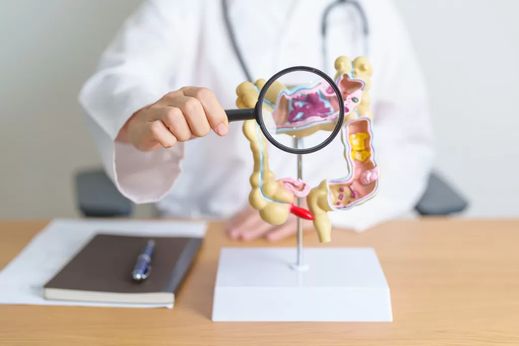 Doctor showing a human colon anatomy model to explain where ulcerative colitis occurs