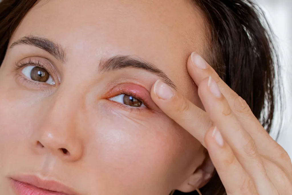 Close up female patient's infected eye with blepharitis