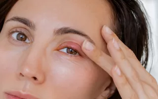 Close up female patient's infected eye with blepharitis