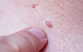 Human papilloma virus HPV on mans skin
