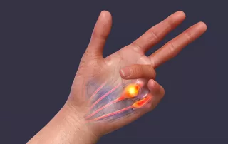 A 3D medical illustration displaying a patient's hand with Dupuytren's contracture, emphasizing the affected tendons and palmar fascia to illustrate the gross pathology of the condition