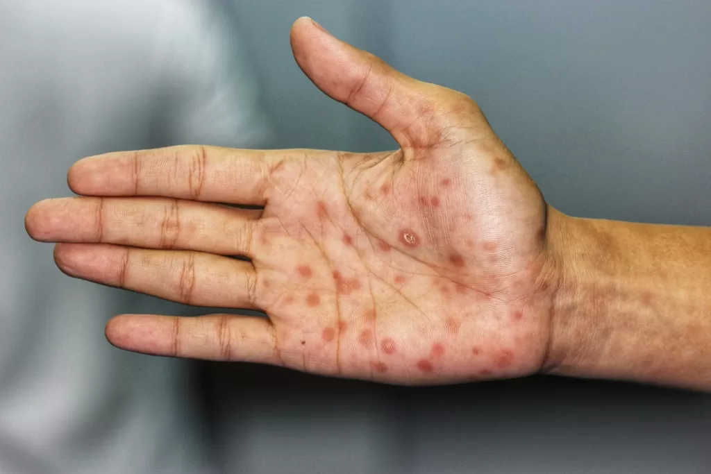 Secondary stage syphilis sores (lesions) on the palms of the hand